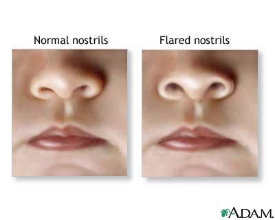 Nasal flaring: MedlinePlus Medical Encyclopedia Image