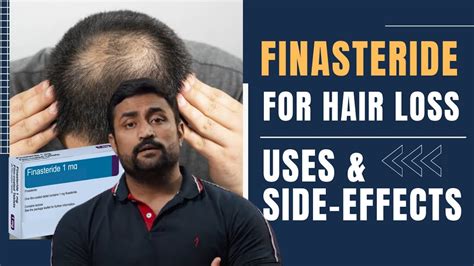 FINASTERIDE FOR HAIR LOSS - USES & SIDE EFFECTS - YouTube