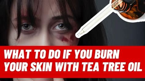 What to do if you burn your skin with tea tree oil - Epic Natural Health