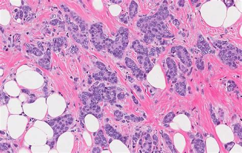 Invasive ductal carcinoma of the breast | MyPathologyReport.ca