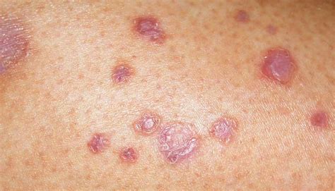 Diabetic skin rash images | Symptoms and pictures