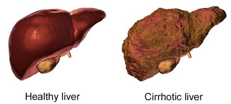 Liver Cirrhosis 5 Symptoms: লিভারের ক্ষত জানান দেয় আগেই, সিরোসিসের কোন ...