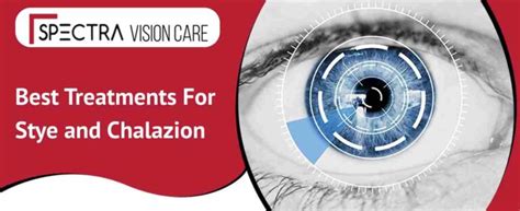 Best Treatments for Stye and Chalazion in India | Chalazion & Stye Treatments