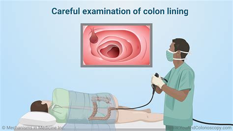 Slide Show - What happens during and after a colonoscopy?