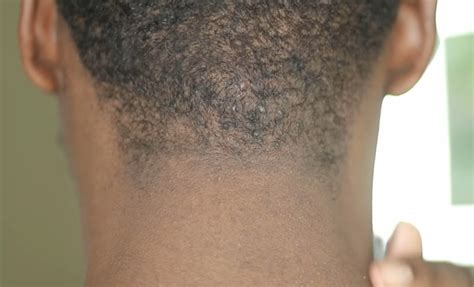 How To Prevent & Treat Razor Bumps On The Back Of Your Head