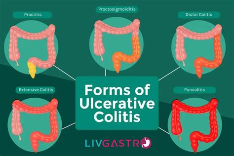 Ultimate Guide to Colitis: Types, Causes, Symptoms & Treatment - LivGastro LivGastro