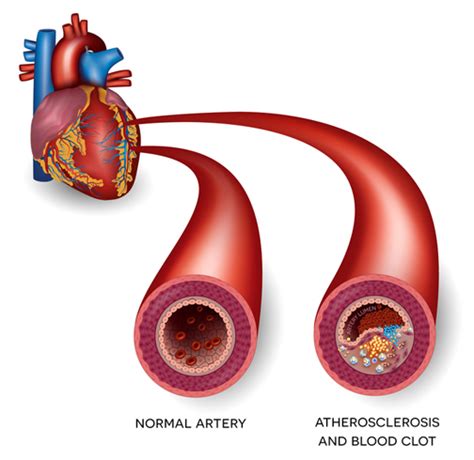 Mild Heart Attack Symptoms: What Do They Mean? - University Health News