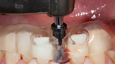 Getting Dental Implants Right with Guided Surgery - Enamel Clinics