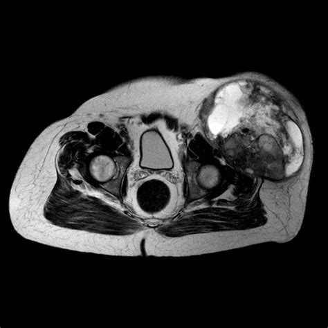 Malignant fibrous histiocytoma | Image | Radiopaedia.org