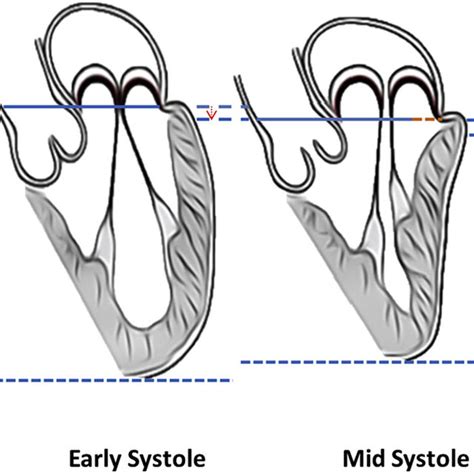 (PDF) Functional anatomy and surgical principles of mitral repair for ...