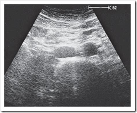 Ultrasound images Aortic bifurcation - Radiology Imaging