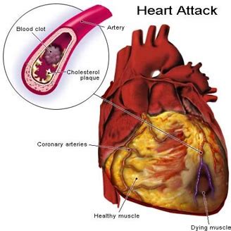 Researchers find how Cholesterol plays a part in Heart disease and ...