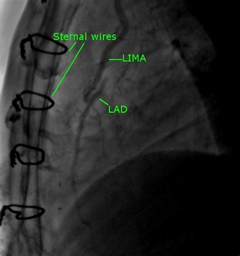 LIMA to LAD coronary bypass graft (CABG) – All About Cardiovascular System and Disorders