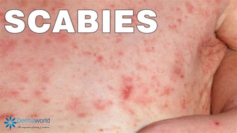 What are Scabies? How are they caused? How to Cure them? - YouTube
