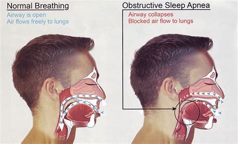 Sleep Apnea Treatment and Prevention - Booboone.com