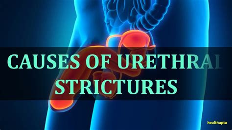 CAUSES OF URETHRAL STRICTURES - YouTube