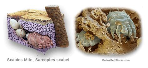 Mites, How to Get Rid of Scabies Mites from Your Body Naturally OBS