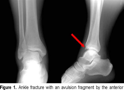 [PDF] Treatment of Anteroinferior Tibiofibular Ligament Avulsion ...