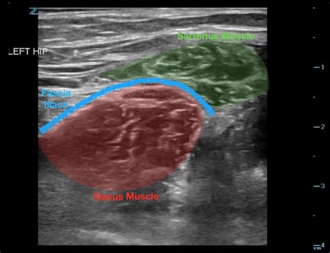 Fascia iliaca nerve block: A hip fracture best-practice Fascia iliaca nerve block: Best ...