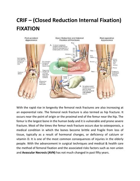 CRIF - Closed Reduction Internal Fixation by Manish Chhaparwal - Issuu