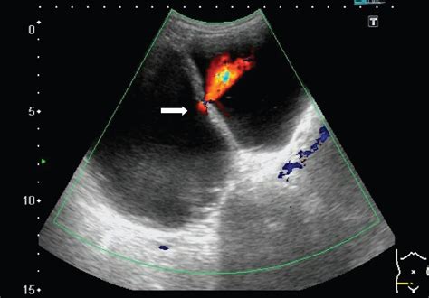 Which one is the urinary bladder? | Annals of Saudi Medicine