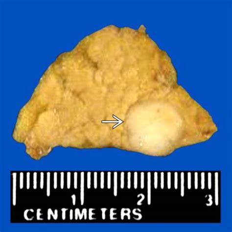 Pancreatic Neuroendocrine Tumors | Radiology Key