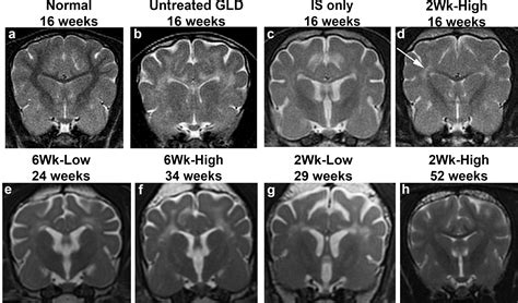 Progress toward a treatment for Krabbe disease | Penn Today