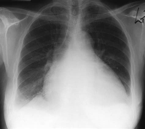 Cardiomegaly Chest Xray