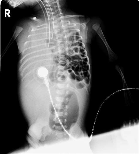 Diaphragmatic hernia chest x ray - wikidoc