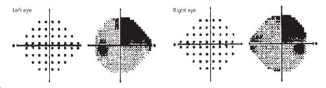 Visual field test showing postablation right superior quadrantanopsia... | Download Scientific ...