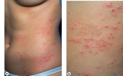 Figure 1 from Autoimmune Progesterone Dermatitis: Potential Role of ...