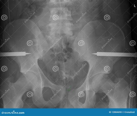 Broken pelvis stock photo. Image of hips, diagnostic - 12884690