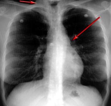 Chest X Ray Asthma