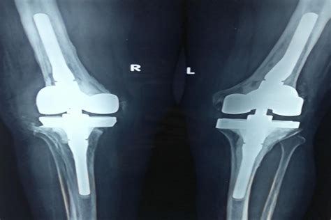 REVISION KNEE REPLACEMENT | Jointreplacementdelhi.com