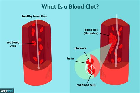 Preventing Blood Clots