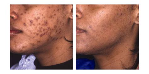 Before and After – Vivant Skin Care