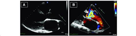 Truncus Arteriosus Echo