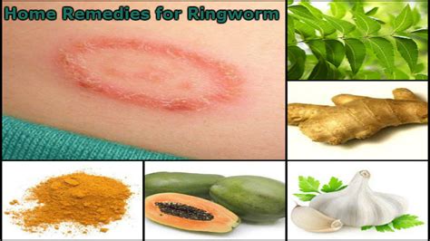 Home Remedies for Ringworm- Daad ki Samasya se Duri Paye