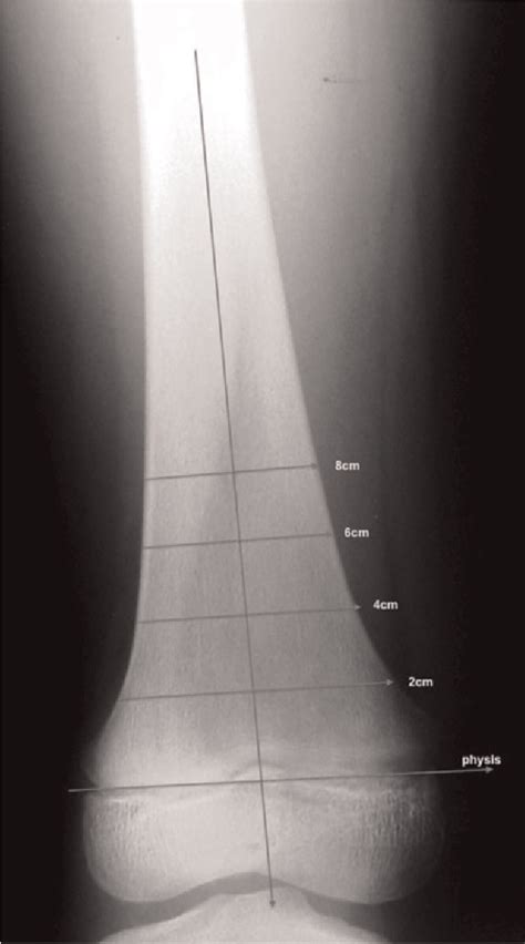 Quantifying the Erlenmeyer flask deformity. | Semantic Scholar