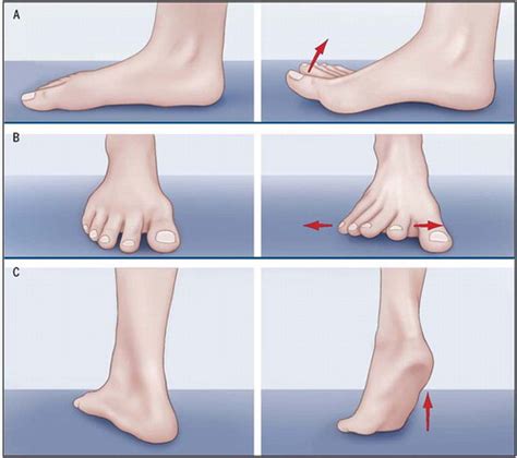 Bunion: Strengthening Foot Muscles to Reduce Pain and Improve Mobility | Journal of Orthopaedic ...