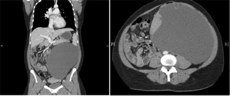 A giant mucinous borderline neoplasm of the mesentery misdiagnosed as an adnexal cyst – a case ...