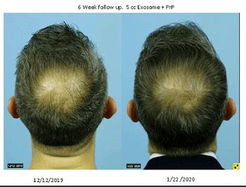 Exosomes and Hair Loss Update | Hair Loss Cure 2020