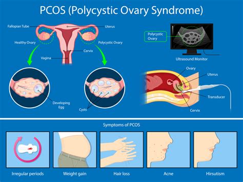 PCOS and Infertility: Causes, Effects on fertility and Complications