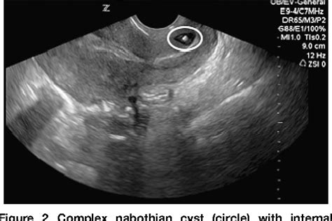 Figure 2 from Cervical ectopic pregnancy diagnosed by point-of-care emergency department ...