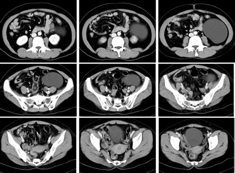 Mesenteric cyst – Radiology Cases