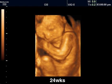 Ultrasound images • Fetus - 24 weeks, 3D, echogramm №310