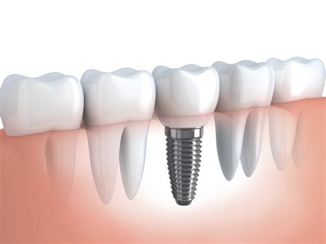 What to Expect after Dental Implant Surgery | Patrick Simone, DDS ...