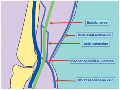 Saphenopopliteal junctions are significantly lower when incompetent. Embryological hypothesis ...