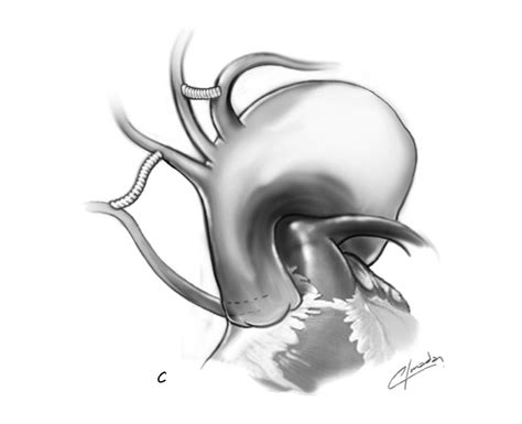 First Step (de-branching): Carotid-subclavian artery bypass on the left... | Download Scientific ...