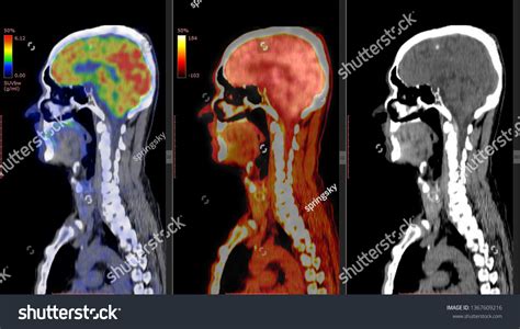 Pet Ct Scan Human Brain Positron Stock Photo 1367609216 | Shutterstock